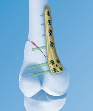 Behandlung Distale Femurosteotomie