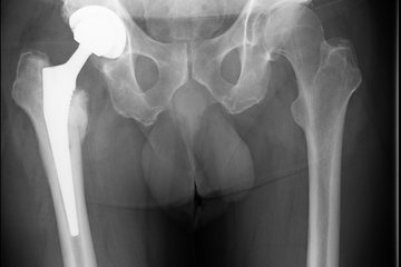 Hueftendoprothese infiziert gelockert Roentgen