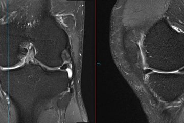 Knorpelschaden Kniegelenk MRT