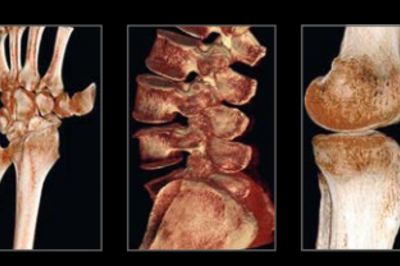 SIEMENS Healthineers 3D Knochendarstellung AKMS