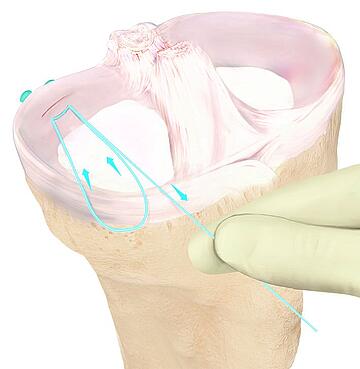 Meniskus Behandlung Schritt 2 Arthrex Grafik