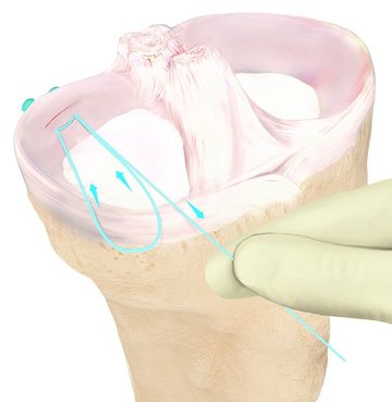 Meniskus Behandlung Schritt 2 Arthrex Grafik