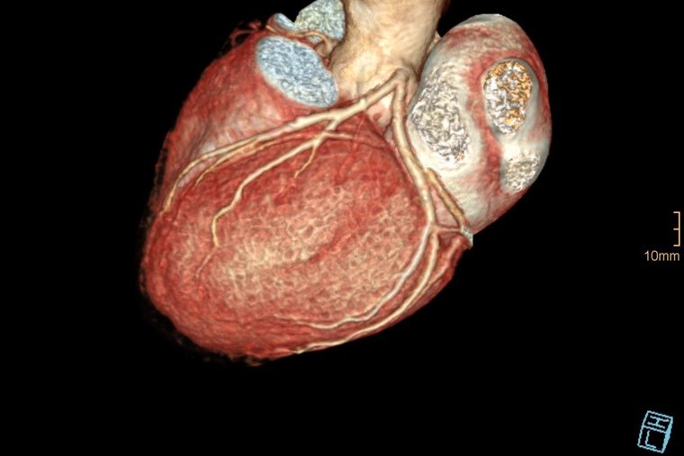 3D Rekonstruktion Herz