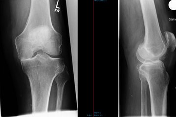 Arthrose medial Kniegelenk Roentgen