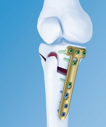 HTO Depuy Synthes Grafik