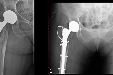 periprothetische Hueftfraktur Roentgen