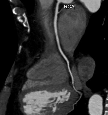 CT Darstellung rechte Herzkranzarterie