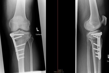 USTO und Knorpelchirurgie Kniegelenk Roentgen