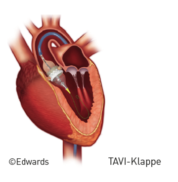 Kathetergestützen Aortenklappenimplantation Grafik