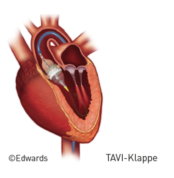 Kathetergestützen Aortenklappenimplantation Grafik