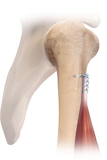 Bizepssehne Arthrex Grafik