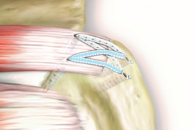Rotatorenmanschette Fadenanker Arthrex Grafik