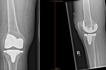 Kniearthrose Oberflaechenersatz Roentgen