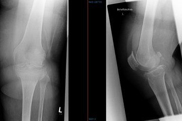 Tibiakopffraktur und Osteoporose Roentgen