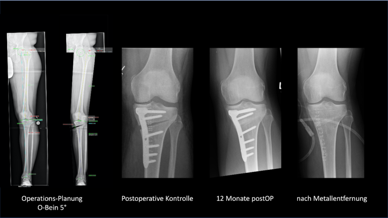 Umstellungsosteotomie Knie Ab Wieviel Grad www.artemed-muenchen-sued.de