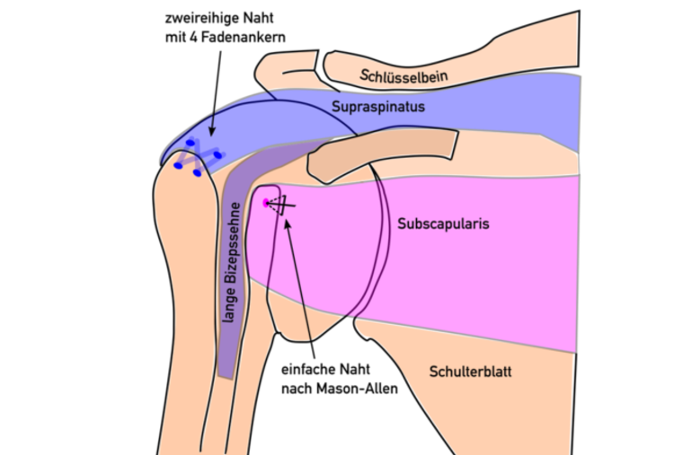 Rotatorenmanschette Grafik beschriftet