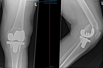 Oberschenkelbruch mit Knieendoprothese Roentgen