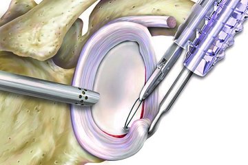 operative Schulterstabilisierung Schritt 1 Arthrex Grafik