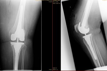 Spezialimplantat postoperativ Roentgen