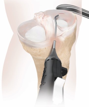 Meniskus Behandlung Schritt 1 Arthrex Grafik