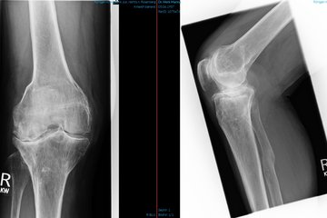 Arthrose vollständig Kniegelenk Roentgen