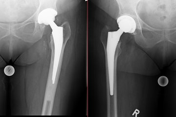 Standardprothese Huefte Roentgen