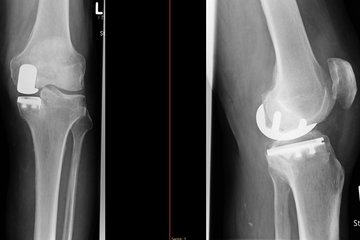 Kniegelenk Schlittenprothese Roentgen